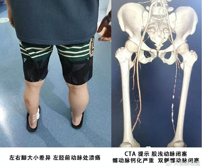 判断,患者同时存在动脉硬化闭塞症及血栓闭塞性脉管炎两种血管疾病,且