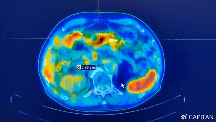 "肿瘤"治疗取得新进展 91岁老人肾癌精准放疗 免疫治疗抑制肿瘤细胞