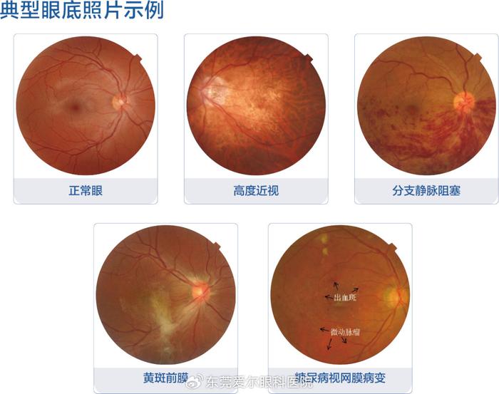 这些人不定期查眼底,后果可能很严重