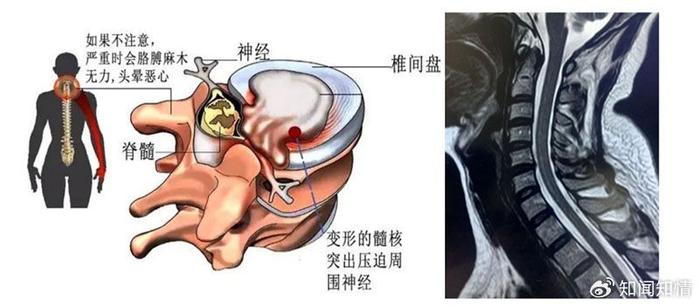 原创科普 胳膊麻木