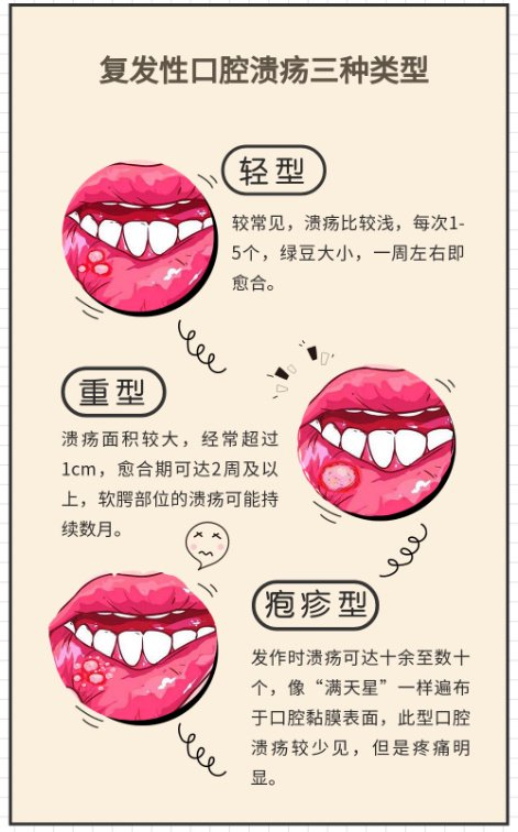 口腔溃疡焊死在我嘴里了,怎么办?