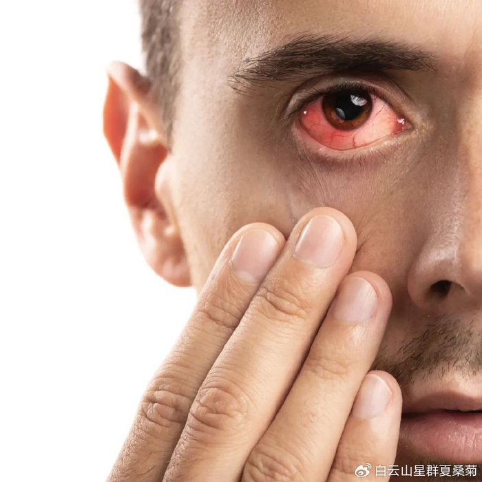 "红眼病"进入高发季节