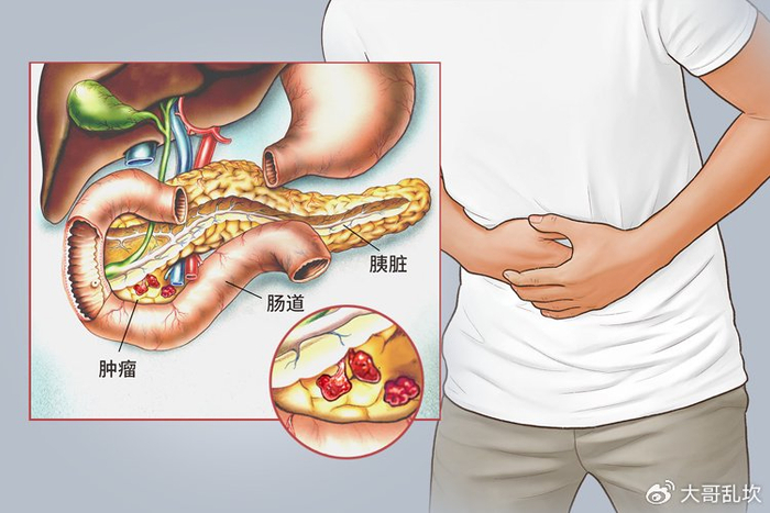 52岁男子每天大便两三次确诊胰腺癌4种异常或是身体警报