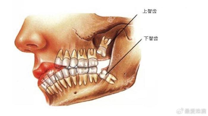 拔智齿翻瓣图片