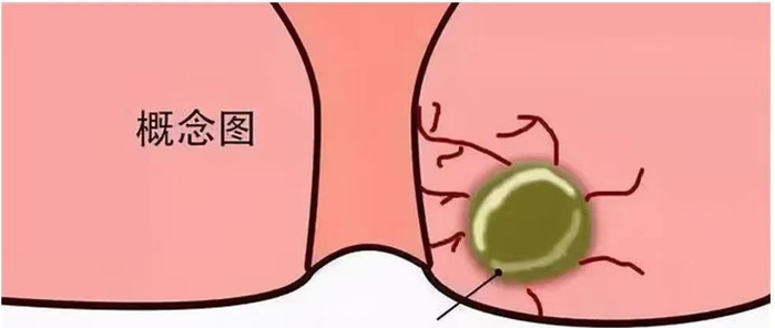 长沙东大肛肠医院:肛周脓肿术后有哪些注意事项?