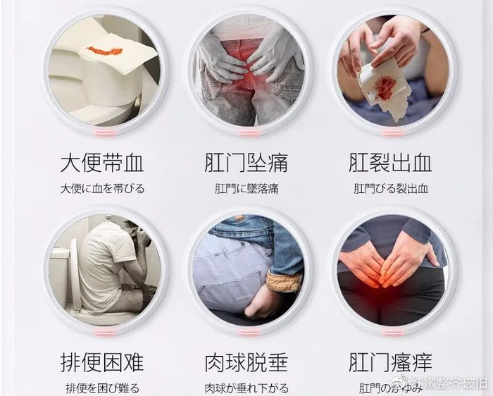 痔疮是怎么引起的? 背后的隐秘真相与有效预防方法!|外痔|内痔|血管|肛门|饮食_新浪新闻