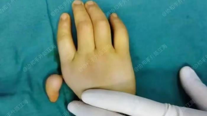 老陈课堂：先天手足畸形——拇指发育不良