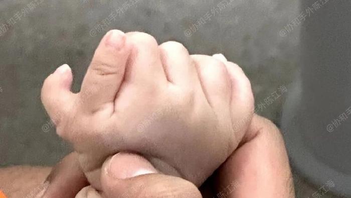 问诊案例3丨多指切掉还会再长出来，这是真的假的？