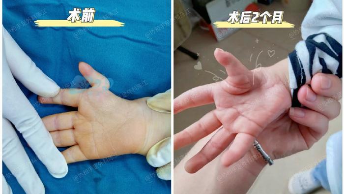 漂浮拇：成功保五指｜案例37 《从抓不住玩具，到能握笔画出直线》