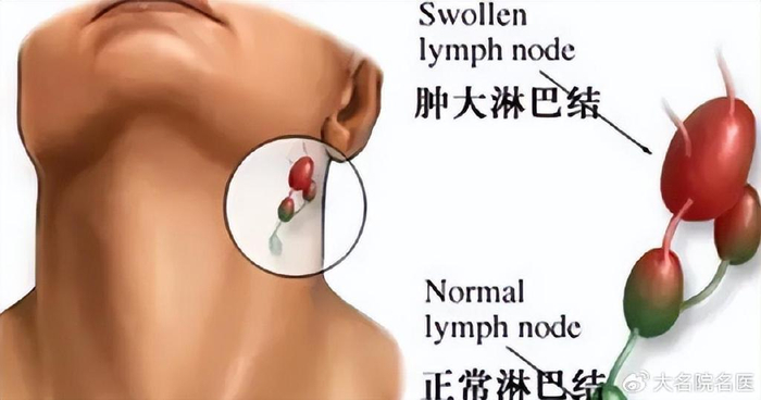 永州市中心医院:超声引导下淋巴结射频消融术开启一个新时代