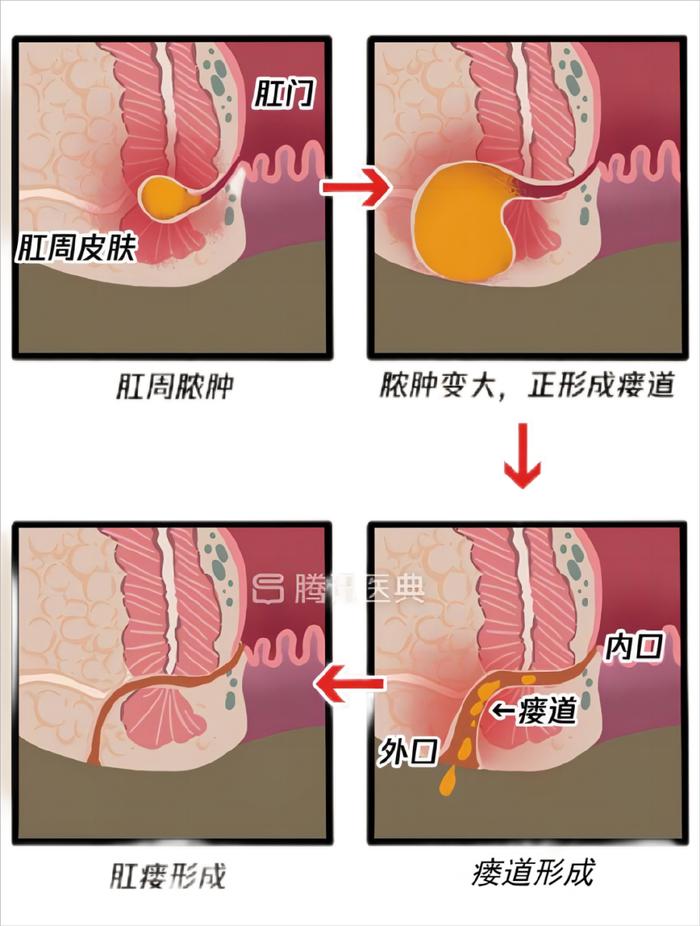 脓肿不切开 如何排脓图片