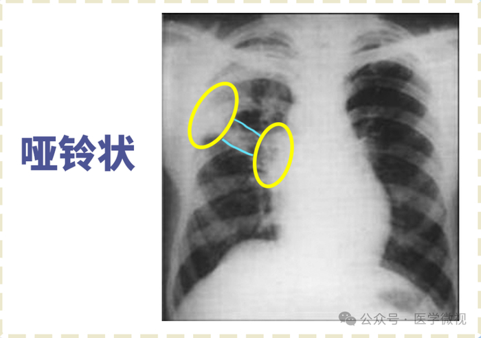 胸片或ct显示肺部弥漫性片状影,磨玻璃结节影,可能是什么情况?