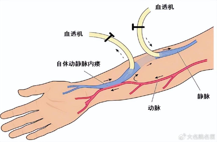 它主要是通过外科手术的方式,将条件适宜的,皮下距离相近的某一动脉和