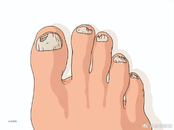 别再用白醋泡脚了,治疗灰指甲的管用方法是这些