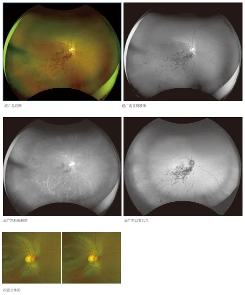 济南普瑞眼科引进欧堡新一代超广角激光扫描检眼镜|广角|眼底|检眼镜