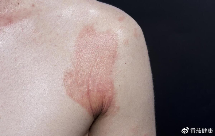 提醒:若身体出现5种症状,或是艾滋来临的信号,望你及早检查