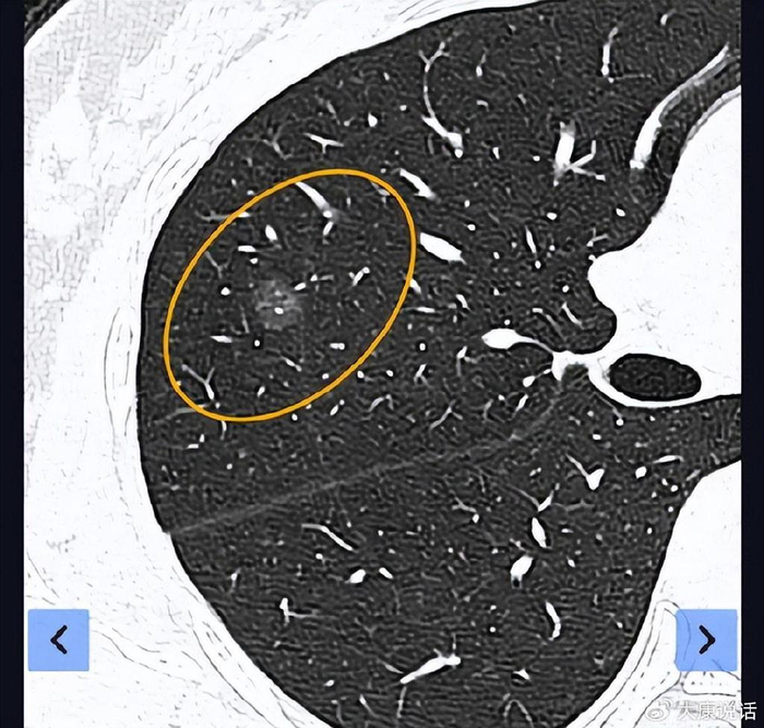 双肺多发磨玻璃结节怎么办先期一网打尽左肺5个腺癌