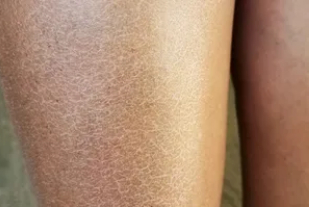 从而使得皮肤中水分流失并变得干燥,出现脱屑,瘙痒,起疹等干性湿疹的