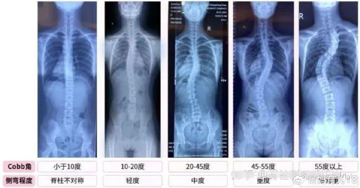 500万中小学生脊柱侧弯,轻的影响身高颜值,重的必须手术