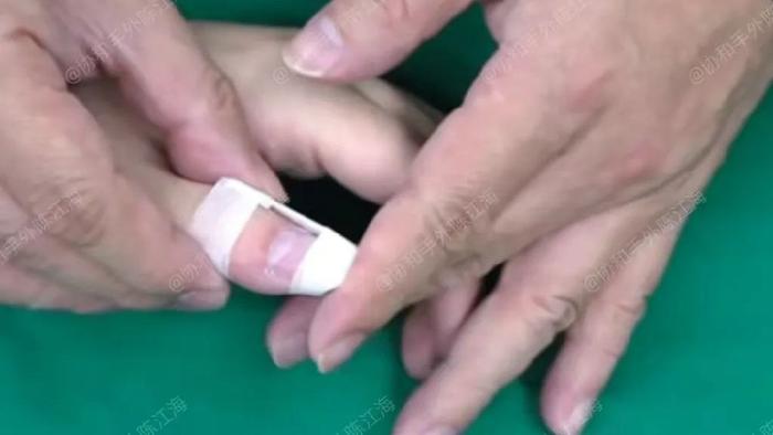 因为做对了这件事，孩子手指7天就从弯到直，妈妈直呼很神奇