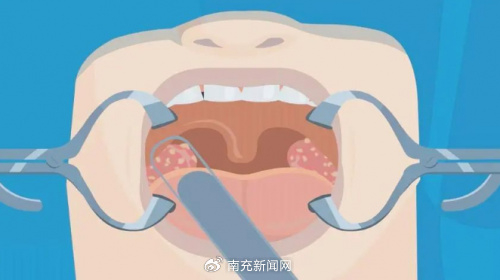 沈阳燕都医院治疗扁桃体怎么样,扁桃体总是发炎?