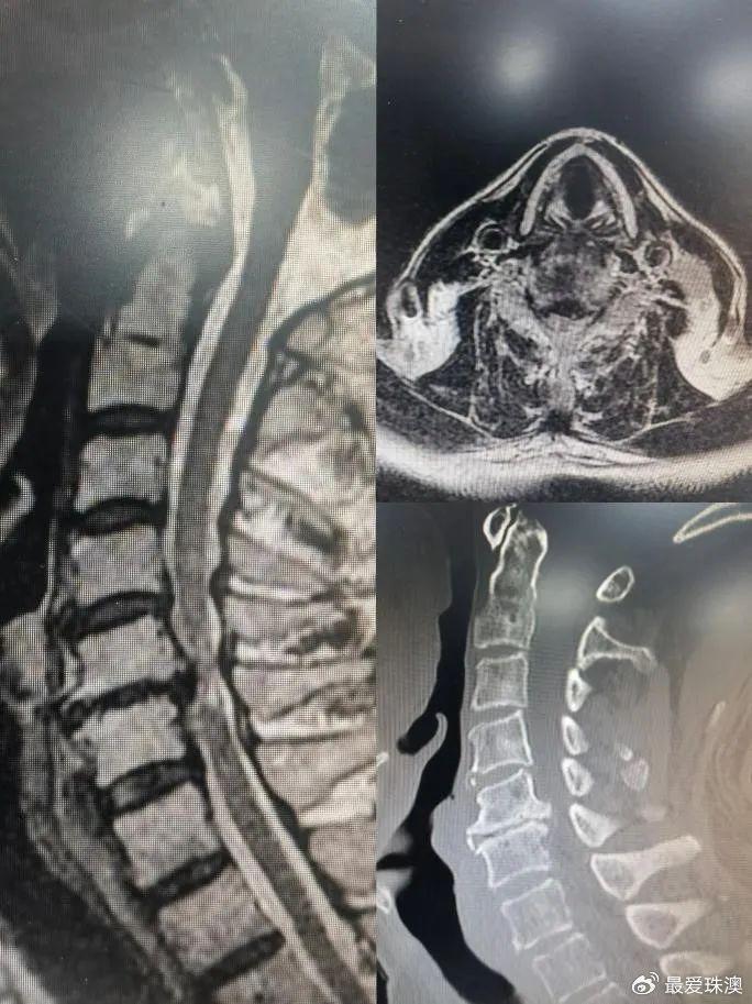颈椎压迫神经手术图片