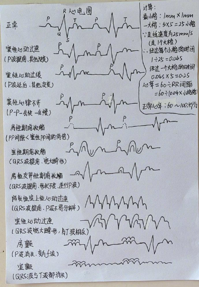 终于有人把心电图怎么看懂讲清楚了 676767