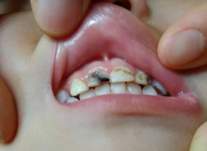 孩子满嘴烂牙,罪魁祸首并非只有糖,5种伤牙行为父母要远离|牙齿|满嘴