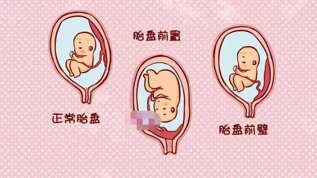 首先,胎盘位于子宫后壁时,其位置相对于腰部更远,与宫颈口之间的联系