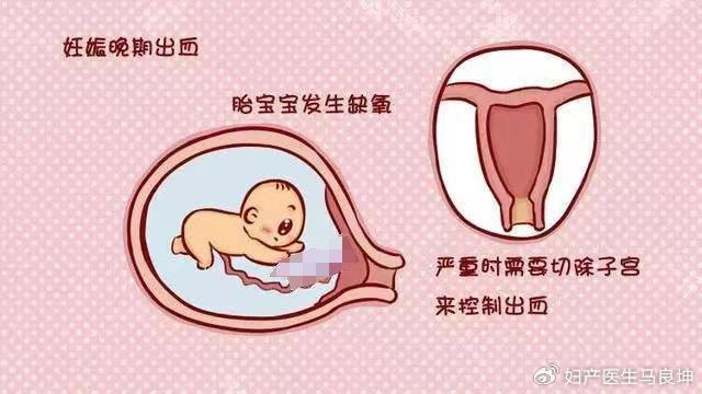 怀孕5个多月的准妈妈遭遇产科“杀手”，这几类孕妈一定要警惕！