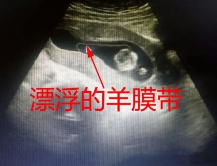 医生:这不是脐带,很危险|羊水_新浪新闻