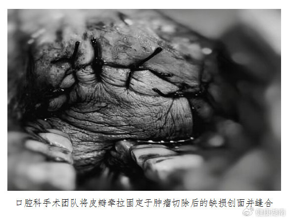 男子颊部"肿瘤"致张口受限,医生小腿"借"皮成功"补脸"