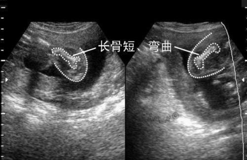 超声显示胎儿四肢偏小,医生安慰:胳膊腿不是特别短小不用担心!
