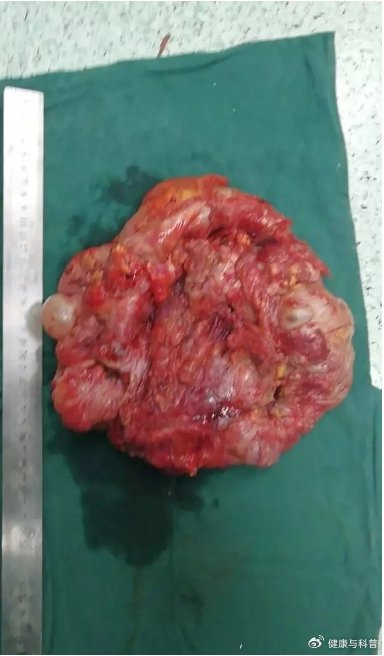 张主任只是很简单告诉我们肿瘤切掉了,肠道也保留了,没有造口.