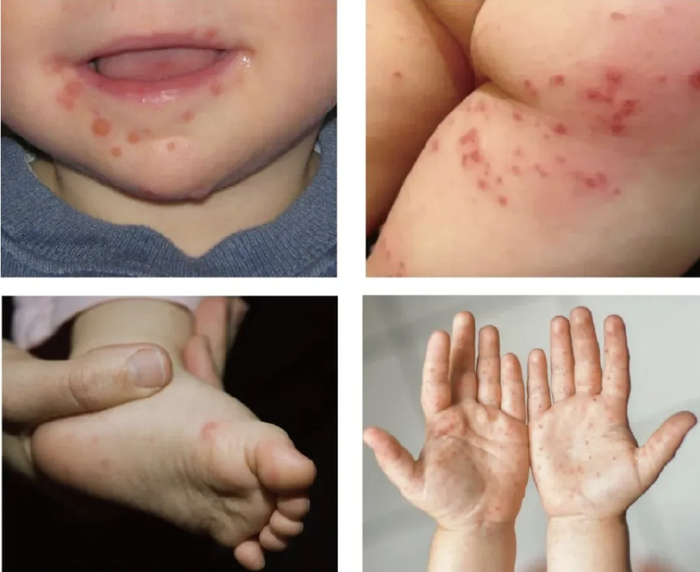 手足口病病原体正在演变,存在暴发风险,预防请做好这些事!
