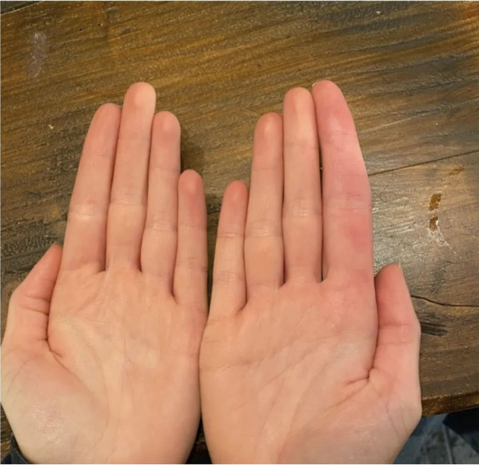 博主们自己展示的各种手部畸形