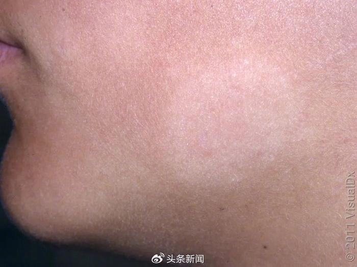 白色糠疹常见于面部,典型的皮疹为圆形或椭圆形的淡白斑,边缘模糊