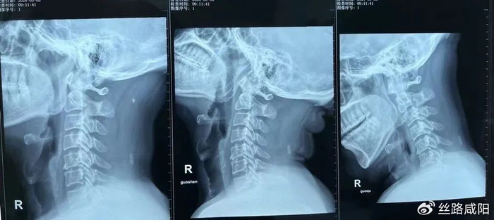 ct示:颈椎骨质增生,颈3/4-6/7椎间盘突出,门诊治疗后症状未见缓解