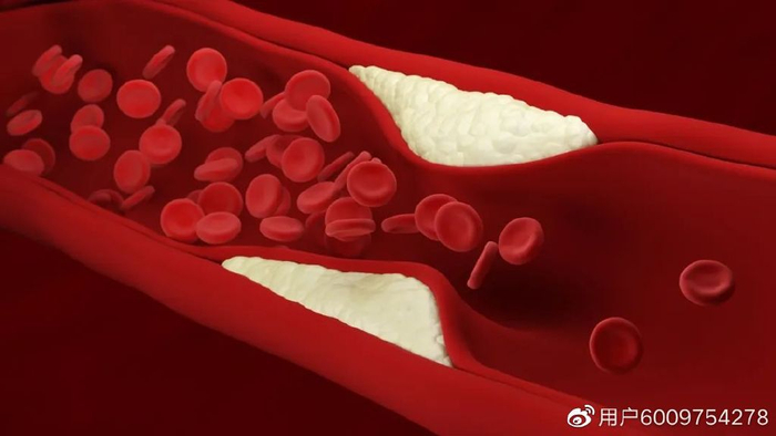 糖尿病是如何破坏血管的？为何80%患者死于心血管并发症？|糖尿病患者|高血糖|心血管疾病|疾病|受损_新浪新闻