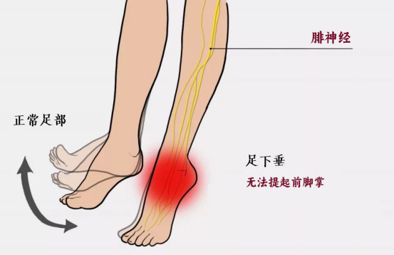 走路"拖脚"难看,如何改善足下垂?