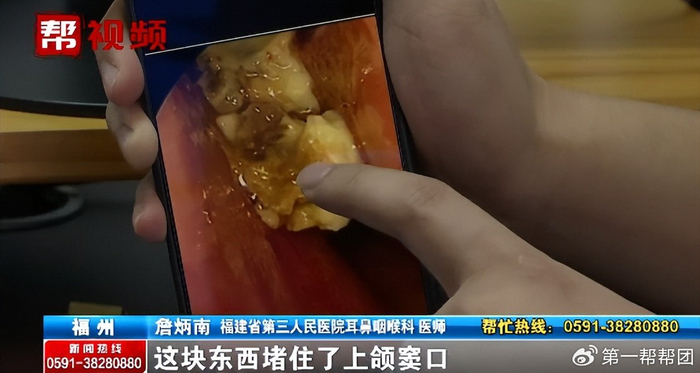 男子鼻塞,失去嗅觉,头疼,竟是鼻子"发霉"了!