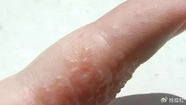 这些"小水泡"为什么这么针对我?