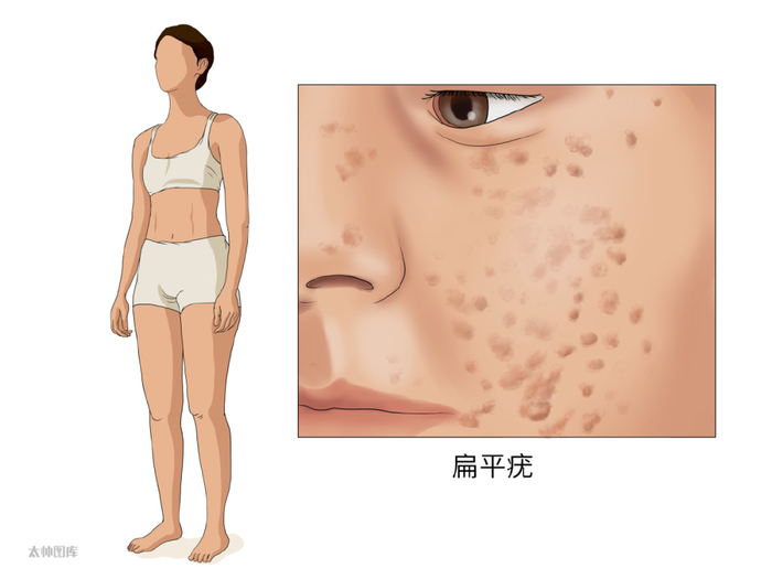 越抠越多!身上长的小疙瘩,或是hpv病毒感染