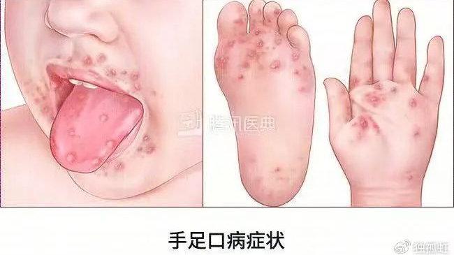 这4种疫苗，建议早点给娃打！最后1种，必须得安排上