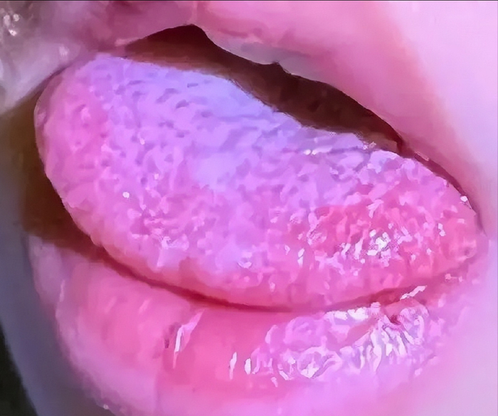 这些患者诊断于1997-1998年的24个月期间,研究发现,33%的典型川崎病