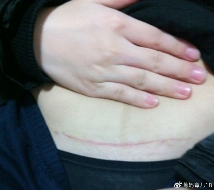 00后宝妈:顺产又疼又挨刀,我要剖腹产!医生痛斥:太无知