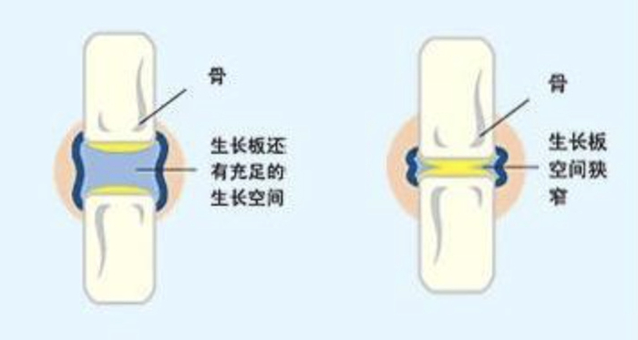 骨骺线会随着年龄的增长逐渐变短,当骨骺与干骺端的软骨完全骨化后