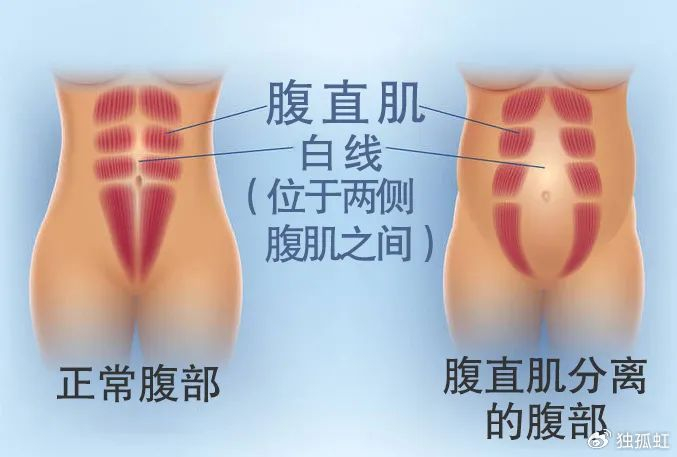 产后腹直肌分离康复技巧|腹直肌|腹部|侧腿_新浪新闻