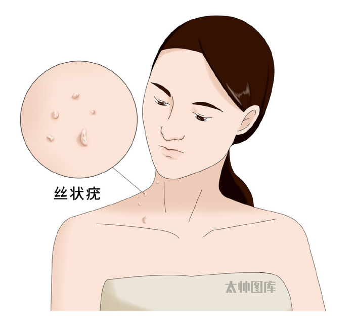 身上长的小疙瘩,或是hpv病毒感染|跖疣|疙瘩|寻常疣_新浪新闻