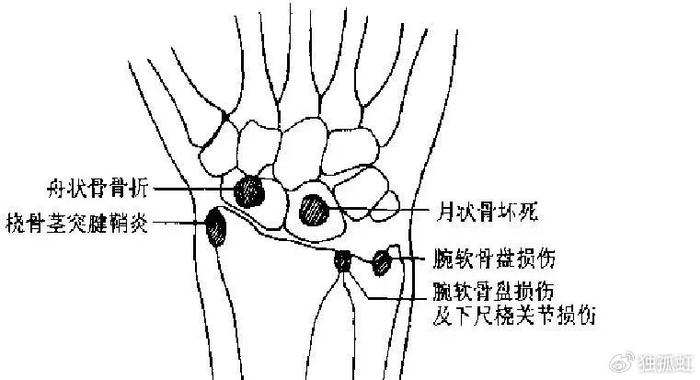 桡侧腕屈肌损伤图片